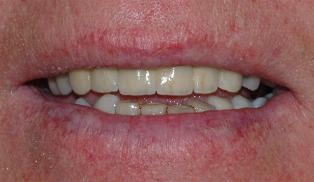 implantat klinisk 5